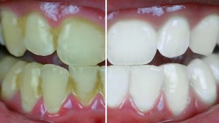 Teeth Whitening At Home In 2 Minutes  पाएं सफेद चमकदार दांत  Anaysa [upl. by Kara975]