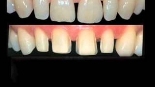 Enjoy Dentistry Enjoy emaxm4v [upl. by Seldon]