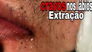 🔴Removendo CRAVOS dos labiosSATISFATÓRIO  cravos na boca 😮 [upl. by Tami]