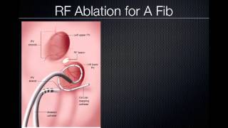 Pulmonary Vein Ablation Cardiac CT [upl. by Roots]