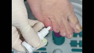 Fungal nail treatment Treatment drops shown in the end [upl. by Obbard809]