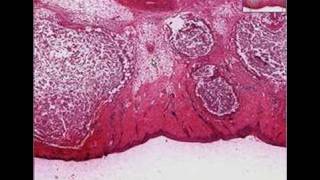 Histopathology Skin  Furuncle abscess [upl. by Niattirb755]