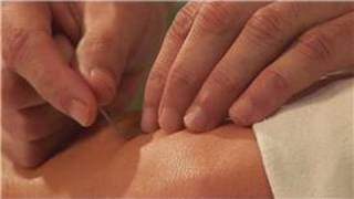 Acupuncture Treatments  Sciatica amp Acupuncture [upl. by Borchert728]