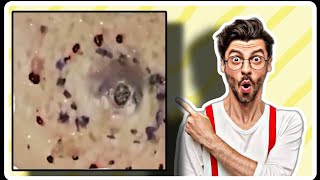 CRAVO GIGANTE NO ROSTO CLIQUE E RELAXE  GIANT BLACKHEAD ON FACE CLICK AND RELAX [upl. by Devine456]