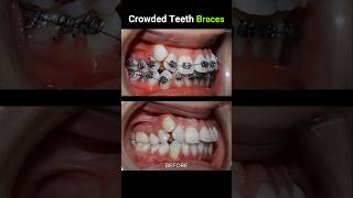 40 months for this braces Crowded teeth braces orthodontist dentist dentistry [upl. by Aruon]