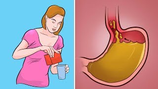 6 Natural Ways To Cure Acid Reflux And Heartburn Without Medication [upl. by Fine795]