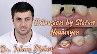 Tooth extrusion by Stefan Neumeyer Dr Islam Shikov [upl. by Sitsuj]