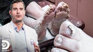 Hongos severos que impactaron a los médicos  Los pies me están matando  Discovery En Español [upl. by Meekahs]