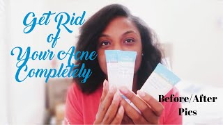 MDacne Review NOT SPONSORED With before and after pictures  How To Use The App  Skincare Routine [upl. by Rodablas]