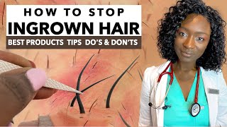 How to Stop Ingrown Hair amp Razor Bumps from Waxing amp Shaving  Treatments amp Products  Black Skin [upl. by Eilarol275]