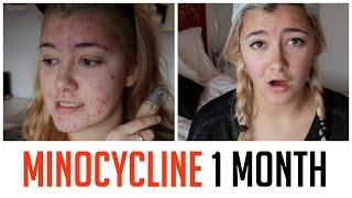 1 MONTH ON MINOCYCLINE UPDATE  HOW I CLEARED MY ACNE [upl. by Costa677]