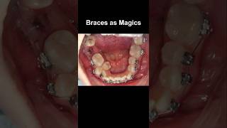 Braces as magics fix all problem braces orthodontist dentist dentistry [upl. by Leitnahs]