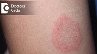 How to manage Chronic Ringworm infection  Dr Rajdeep Mysore [upl. by Garry384]