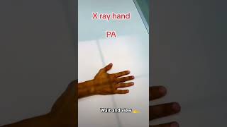 ☢️ xray hand ap lateral oblique viewxray shorts radiological tranding 🫴🩻 [upl. by Nosduh]