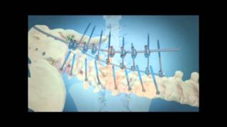 Scoliosis Surgical Correction with Instrumentation [upl. by Kciredor]