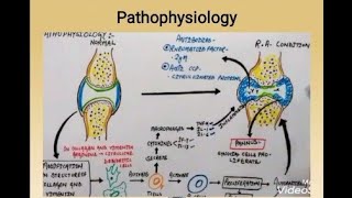 Rheumatoid Arthritis aetiology pathophysiology different stages [upl. by Isaiah]