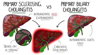 Primary Sclerosing Cholangitis v Primary Biliary Cholangitis Primary Biliary Cirrhosis [upl. by Brunhild596]