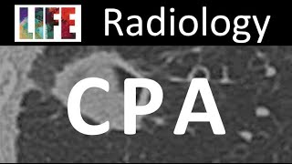 Radiology of chronic pulmonary aspergillosis [upl. by Alocin]