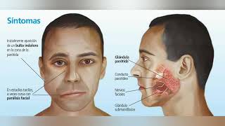 SIALOADENITIS INFECCIÓN DE LAS GLANDULAS SALIVALES BULTO EN REGION MAXILAR [upl. by Eide]