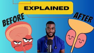 What you didnt know about an Enlarged Prostate Benign Prostatic Hyperplasia [upl. by Ytitsahc865]