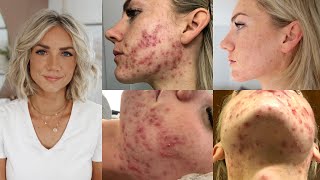 How I Cured My Adult Hormonal Cystic Acne Naturally no accutane [upl. by Redwine]