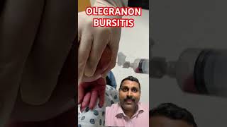 OLECRANON BURSITIS [upl. by Yeh]