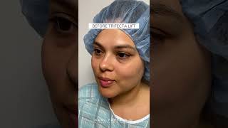 Before amp After Trifecta Lift  Latina Patient  Dr Kami Parsa Beverly Hills [upl. by Sackman]