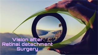 12 How Is VISION after retinal detachment surgery  RETINAL DETACHMENT retinaldetachment [upl. by Conway]