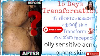 ✅15 Days Skin Transformation Videoskintransformers skintransformation skintransformationchallenge [upl. by Yancey]