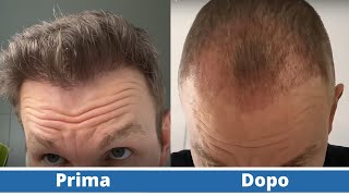 Trapianto di capelli prima e dopo  Stempiatura [upl. by Pelpel]