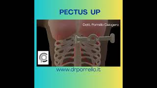 PECTUS UP DOTT PORRELLO [upl. by Nodababus]