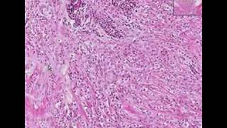 Histopathology BreastLobular carcinoma [upl. by Judie]